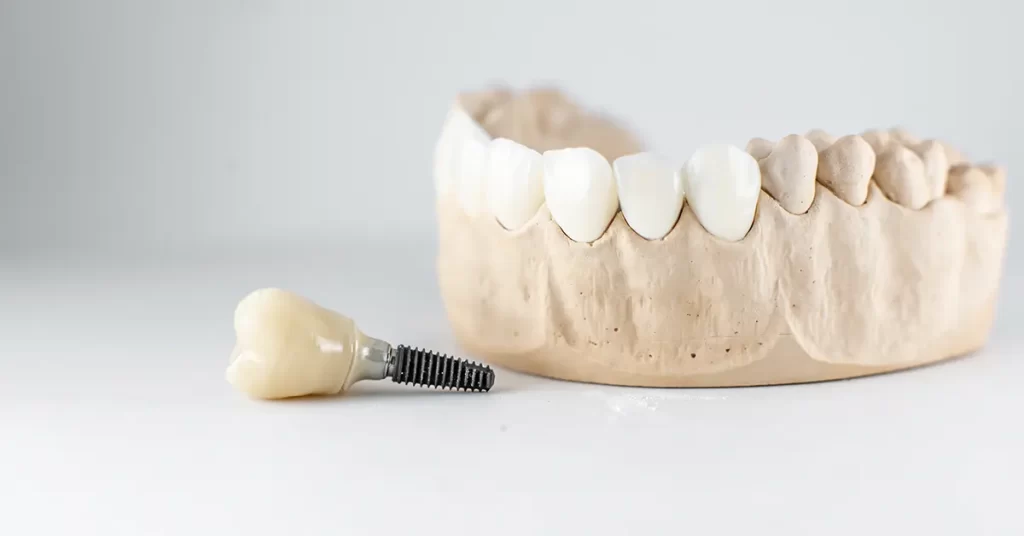 Um implante é colocado e suporta uma única coroa