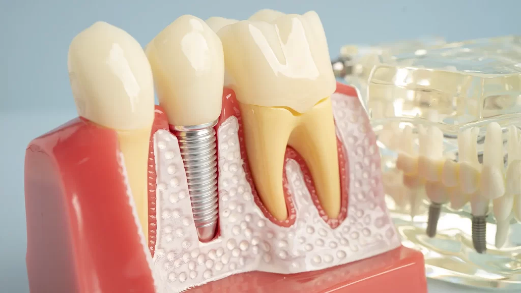 A Mund Concept Reabilitação Oral criou um guia completo sobre Implantes Dentários