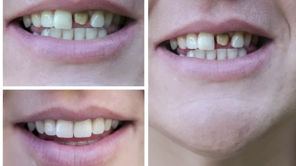 volte a sorrir com confiança com a solução das facetas dentárias da Mund Concept Reabilitação Oral em Botucatu e Região