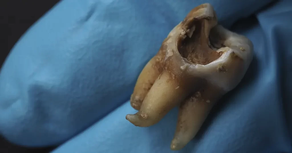evite que as cáries destruam seus dentes a restauração dentária na mund concept botucatu e regiao
