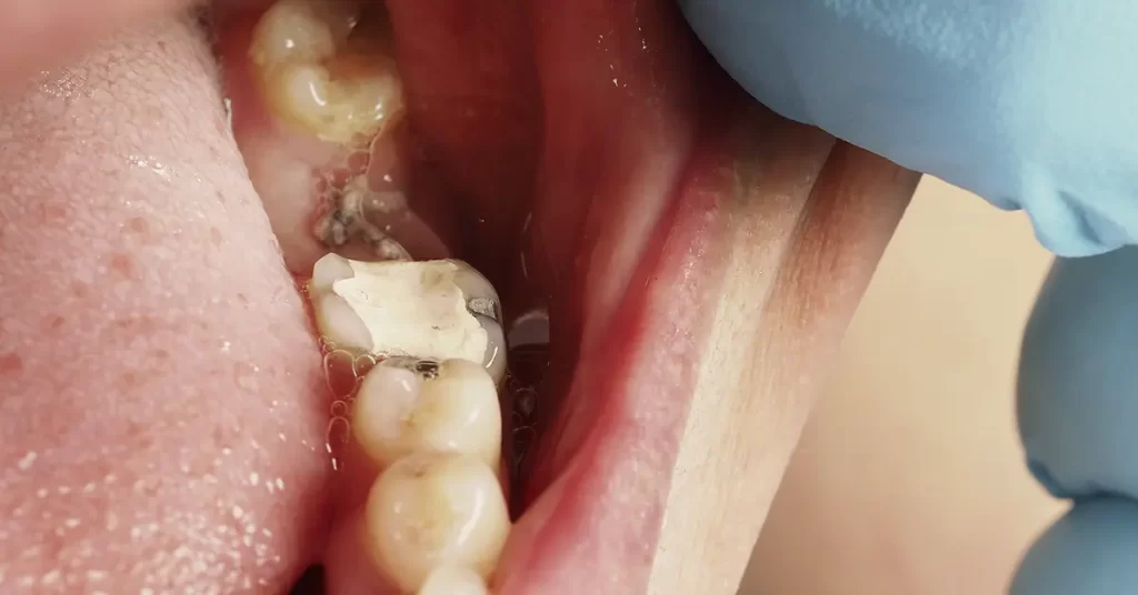 Dentista da Mund Concept em Botucatu realizando procedimento de restauração dentária com tecnologia e precisão.