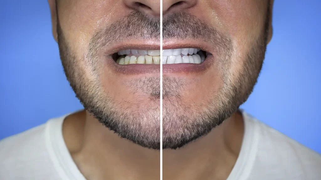 Ilustração de dentes com manchas, lascas, diastema e desalinhamento corrigidos por facetas dentárias