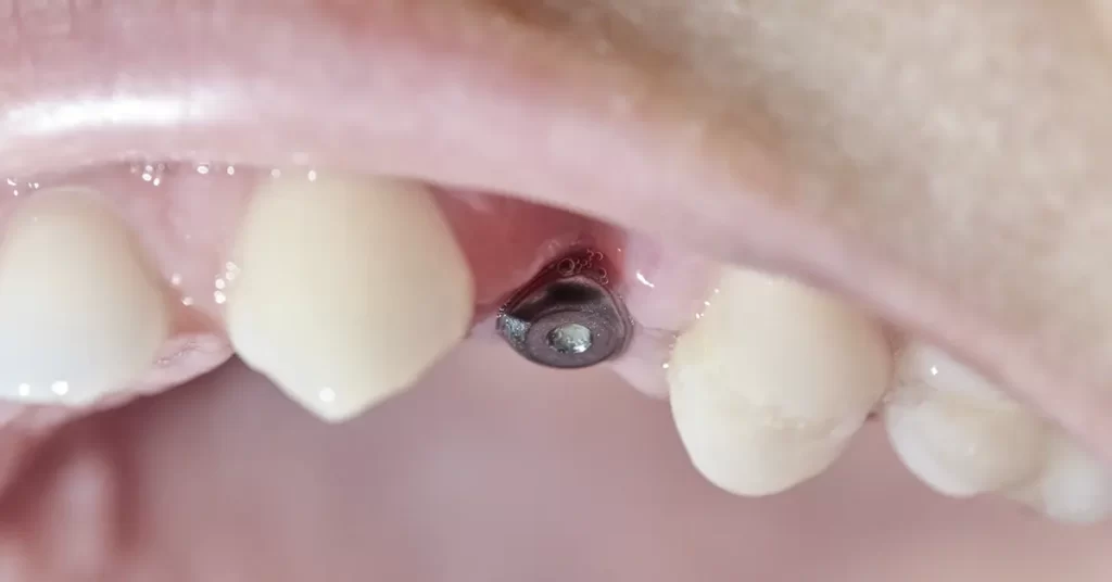 Eu sou um bom candidato para implantes? Descubra com a Mund Concept Reabilitação Oral