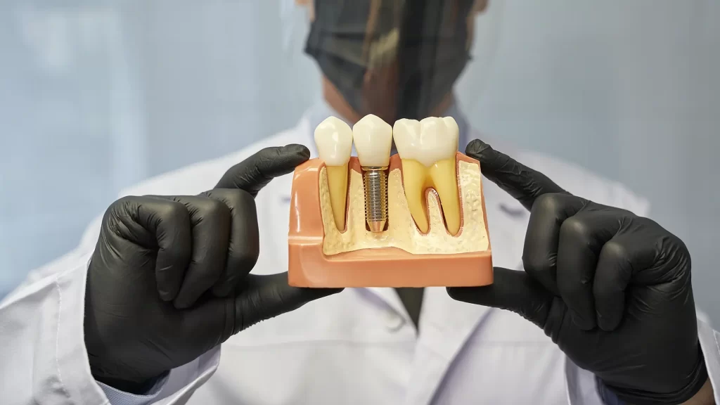 Guia passo a passo implante dentário, tipos de prótese sobre implante, vantagens implante dentário, cuidados após cirurgia implante Mund Concept