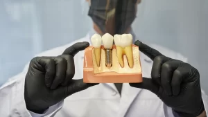Guia passo a passo implante dentário, tipos de prótese sobre implante, vantagens implante dentário, cuidados após cirurgia implante Mund Concept