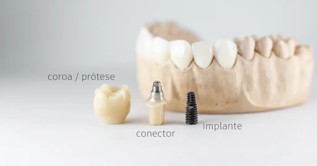 Diagrama ilustrando as partes de um implante dentário (pino, abutment, prótese) e o processo de osseointegração no osso da mandíbula para reabilitação oral em Botucatu.