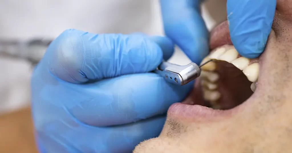 Restauração estética de resina composta em dente frontal, mostrando a naturalidade do tratamento na Mund Concept em Botucatu.