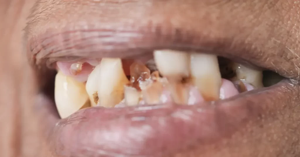 recupere seu sorriso e sua saude bucal com a restauração dentária da mund concept reabilitação oral