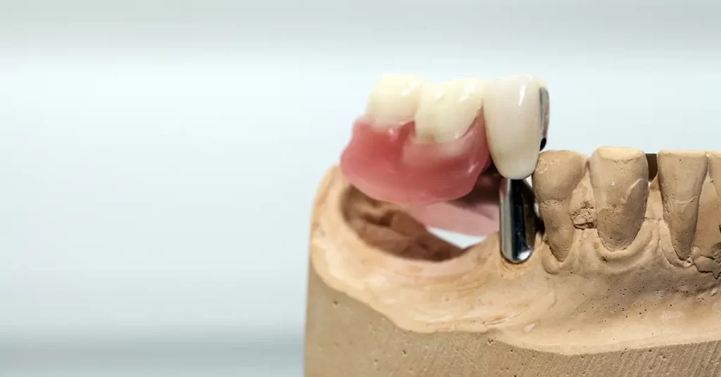 descubra a melhor prótese dentária em Botucatu e Região