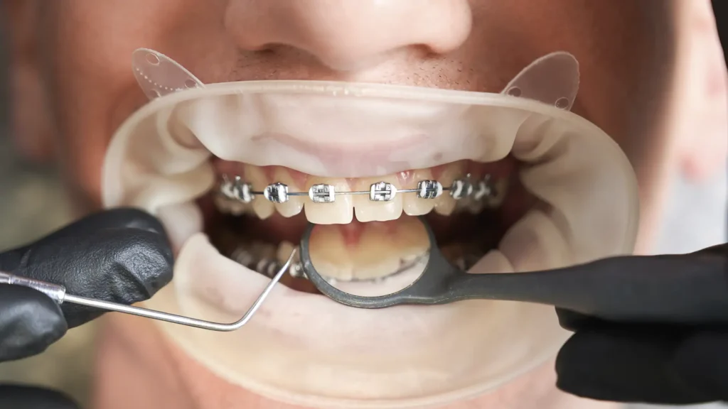 Comparativo de aparelhos ortodônticos (fixos, estéticos, invisíveis) disponíveis na Mund Concept em Botucatu, para alinhar sorrisos de crianças e adultos da cidade e região.