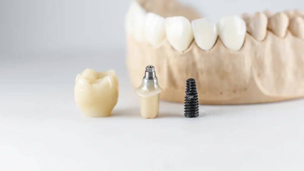 Imagem detalhada de modelo de implante dentário realizado na Mund Concept em Botucatu, desde a colocação até a prótese, com tecnologia avançada para pacientes de Botucatu e arredores.