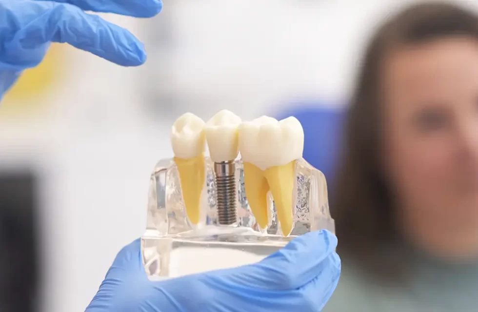 etapas do tratamento de implante dentário para reabilitação oral em Botucatu: consulta, cirurgia, cicatrização (osseointegração), instalação do abutment e colocação da prótese final.
